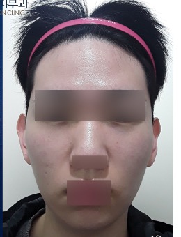 韓國EVER皮膚科男士聯(lián)合治療蛻變術(shù)例解析:告別生硬輪廓,解鎖柔和線條