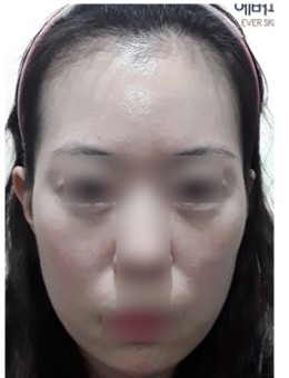 韓國韓國EVER皮膚科面部年輕化實(shí)例分享：太陽穴、臉頰凹陷等多個(gè)問題得到了解決！