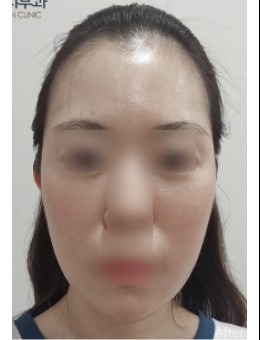 韓國韓國EVER皮膚科面部年輕化實(shí)例分享：太陽穴、臉頰凹陷等多個(gè)問題得到了解決！