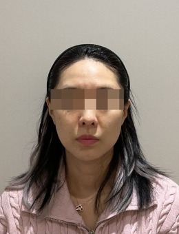 一日轮廓重塑:韩国ONU皮肤科全脸紧致提升术真实术例前后对比解析！