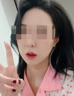 一日轮廓重塑:韩国ONU皮肤科全脸紧致提升术真实术例前后对比解析！