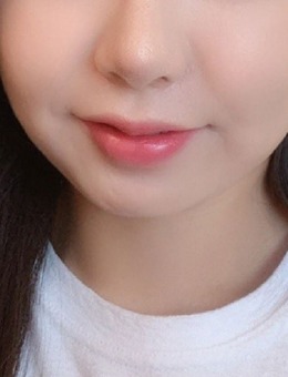 韩国UYOU整形V脸术例记录：从圆润脸到精致轮廓的蜕变