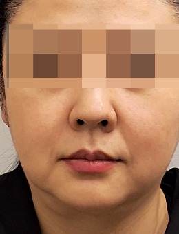 韩国the mentor德蔓特整形抗衰实例曝光：轮廓拉皮联合光雕提升，组织深层复位，清晰下颌缘一秒即现！