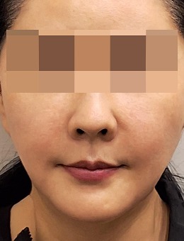 韩国the mentor德蔓特整形抗衰实例曝光：轮廓拉皮联合光雕提升，组织深层复位，清晰下颌缘一秒即现！