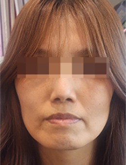 韩国the Beauty整形全脸微调填充玻尿酸实例分享，实拍前后样貌变化，讲解填充细节与整体结果！
