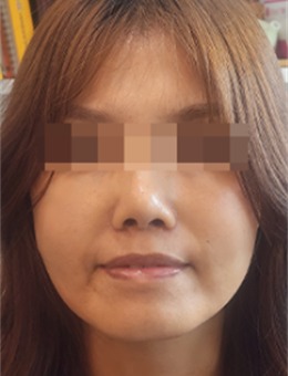 韩国the Beauty整形全脸微调填充玻尿酸实例分享，实拍前后样貌变化，讲解填充细节与整体结果！