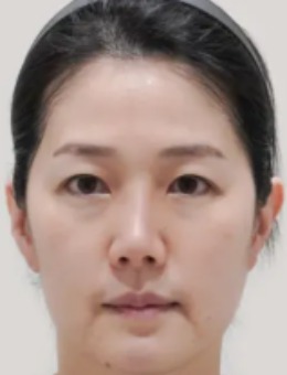 韩国DICARAT新沙医院玻尿酸填充前后真实对比来了！注射后get元气少女感！