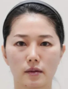 韩国DICARAT新沙医院玻尿酸填充前后真实对比来了！注射后get元气少女感！