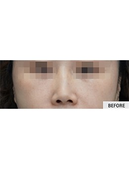 韩国THE BEAUTY皮肤科｜法令纹填充不踩雷心得