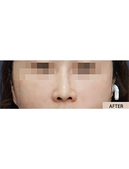 韩国THE BEAUTY皮肤科｜法令纹填充不踩雷心得