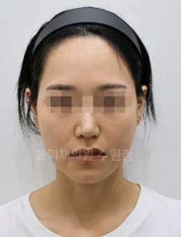 奥丽绽颜皮肤诊所水原店｜提拉紧致抗衰真实日记！_术后