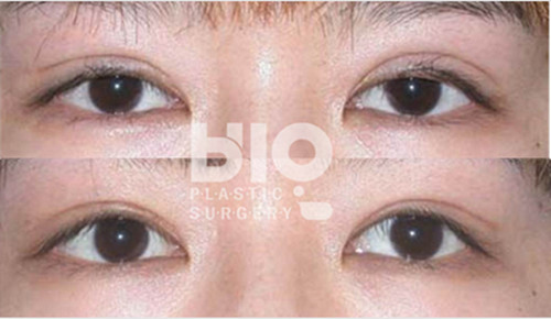 韩国BIO整形外科眼部案例