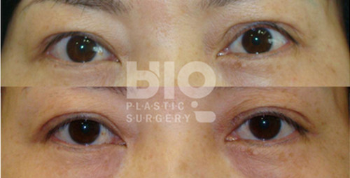 韩国BIO整形外科眼部案例