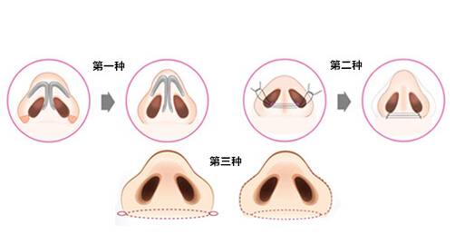 鼻子缩小手术手术方法