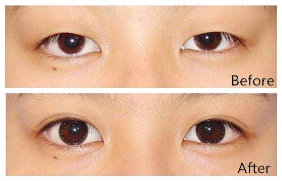 韩国德丽珍整形医院双眼皮对比图