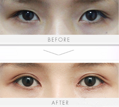 韩国丽延长整形外科 双眼皮对比图