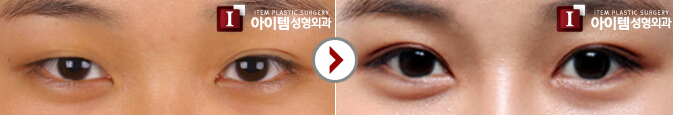 韩式双眼皮整形对比案例