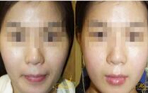 韩国美自人面部轮廓对比图