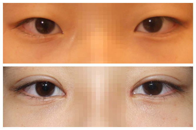 韩国ucanb整形医院双眼皮对比图