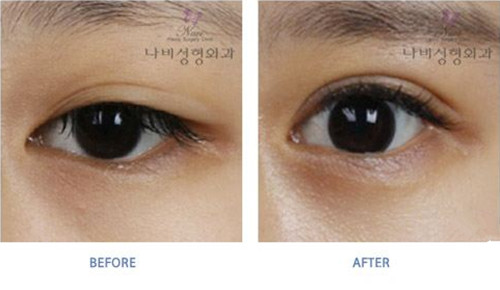 韩国娜飞整形医院双眼皮手术对比图