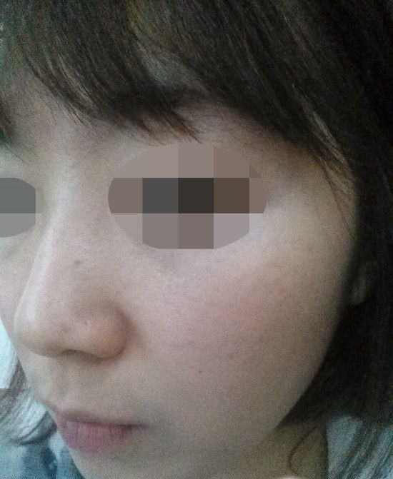 韩国美典 激光祛斑术后15天