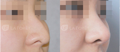 韩国LAFORET整形医院隆鼻手术对比图