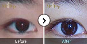 韩国metop整形医院双眼皮对比图