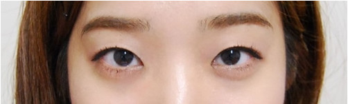 韩国IVE整形外科医院 双眼皮手术案例