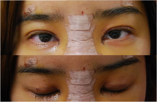 韩国IVE整形医院 双眼皮+隆鼻手术第四天