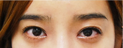 韩国IVE整形医院 双眼皮+隆鼻术后第五天