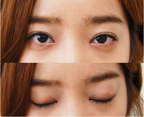 韩国IVE整形医院  双眼皮+隆鼻术后两个月