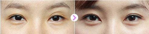 韩国ive整形医院双眼皮对比图