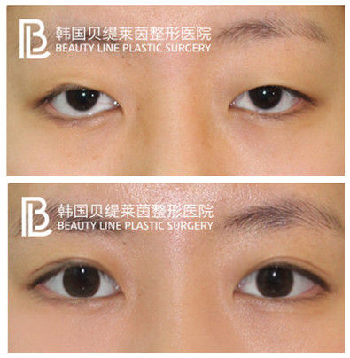 韩国贝缇莱茵整形外科双眼皮对比图