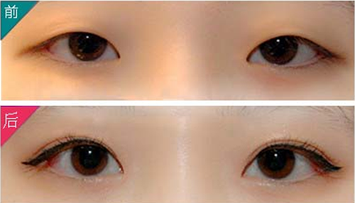 双眼皮手术案例对比图