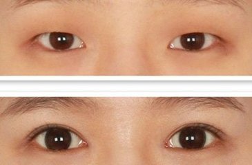 双眼皮手术案例对比图 韩国李政自然美整形外科