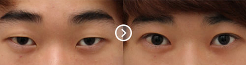 双眼皮手术案例对比图 韩国美知整形外科