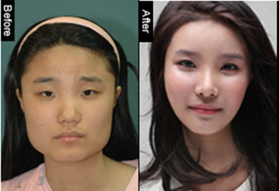 面部轮廓对比图韩国延世真整形外科