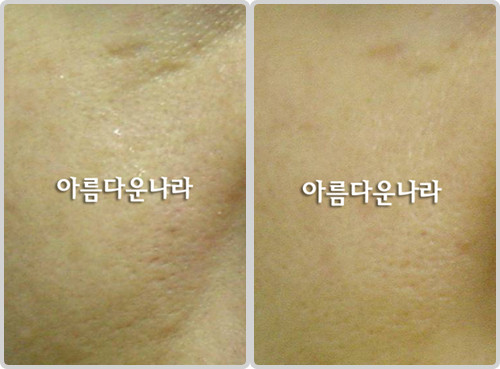 韩国安娜可琳皮肤科毛孔缩小对比图