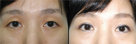 双眼皮对比图韩国sein整形外科