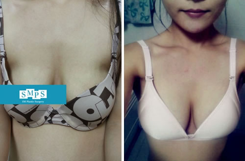 韩国smps胸部下垂矫正对比案例