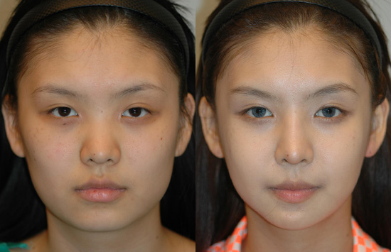 面部轮廓对比图韩国romian路美颜整形外科