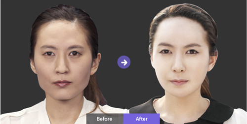 韩国neo整形外科 面部轮廓对比图