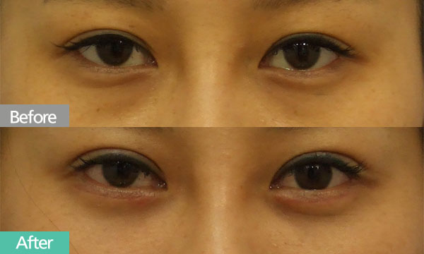 韩国拉本整形外科 黑眼圈对比日记