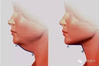 双下巴和甲状腺区别图图片