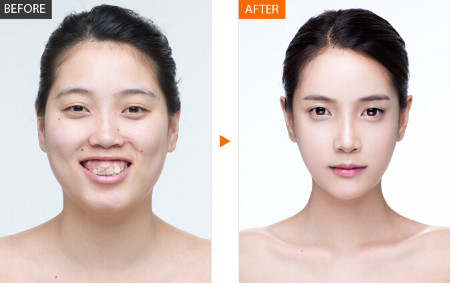 韩国巴诺巴奇整形外科 面部轮廓对比