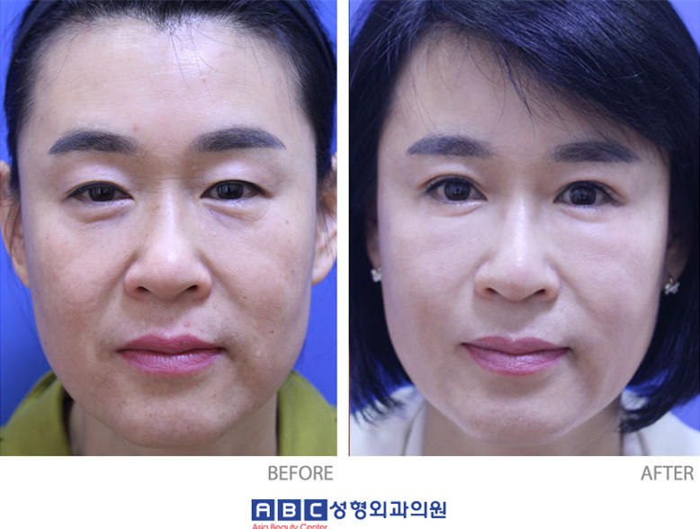 双眼皮对比图韩国abc整形医院