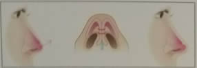 针对型鼻尖手术方法.jpg
