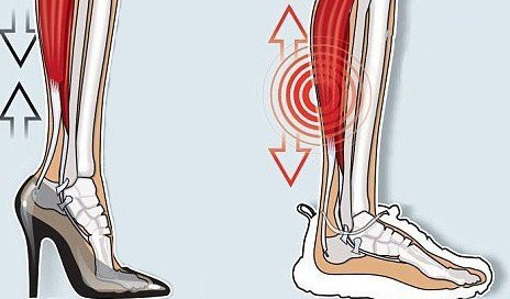 穿高跟鞋导致肌肉腿 示意图