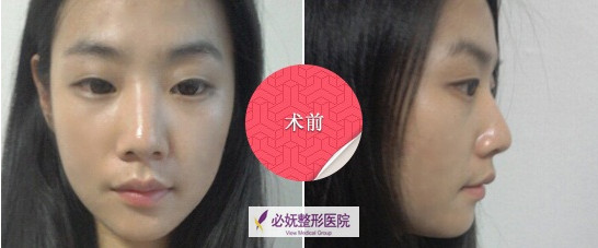 韩国双眼皮手术术前照片