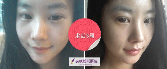 韩国双眼皮+隆鼻手术恢复过程 第三周